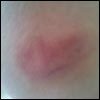 Madonna: "heart shaped bruise on my ass"